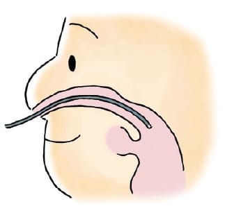 経鼻挿入イメージ